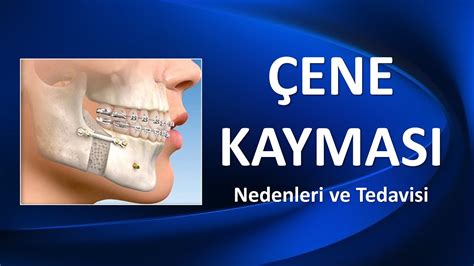 Çene Tedavisi İyileşmesi