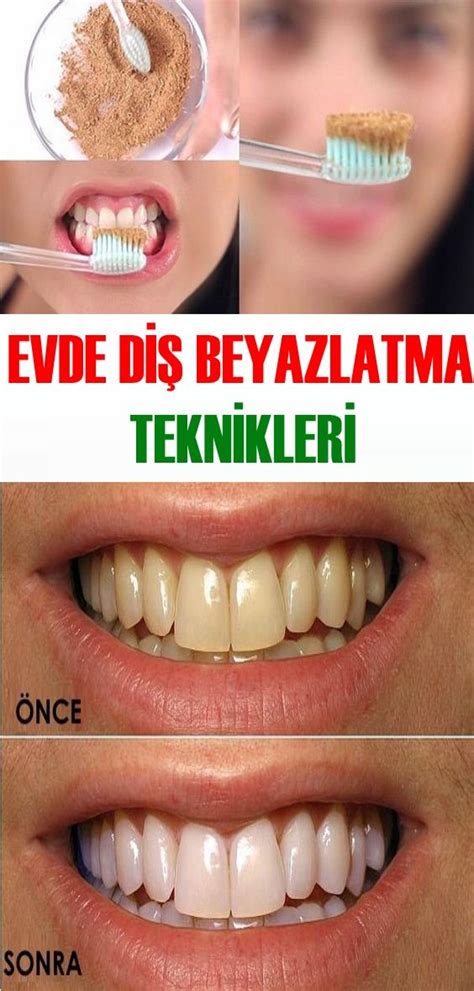 Evde Diş Beyazlatma Teknikleri