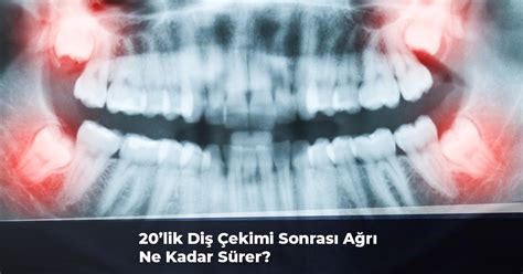 Gömülü 20'lik Diş Çekimi Sonrası Ağrı Ne Kadar Sürer?