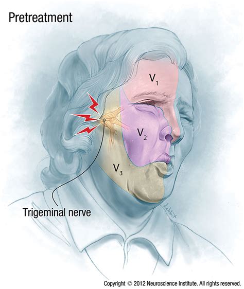 Trigeminal Nöralji